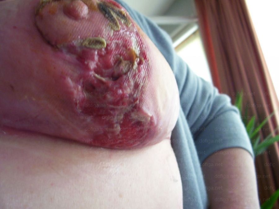 mamoplastia-infectada-3