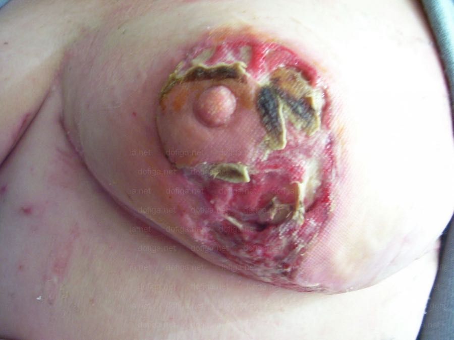 mamoplastia-infectada-4