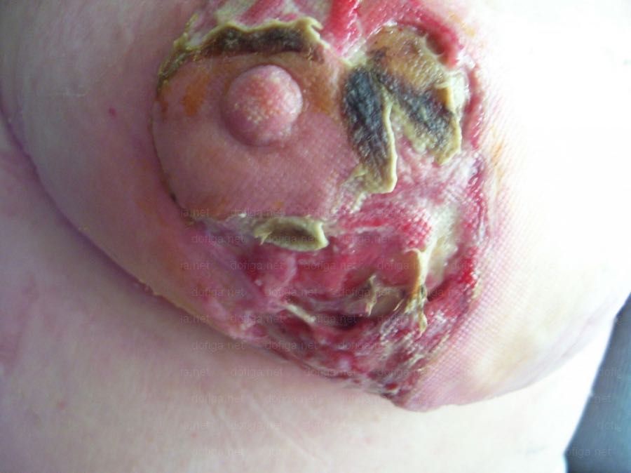 mamoplastia-infectada-5