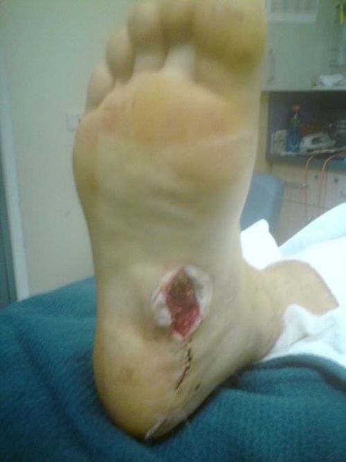 foot_puncture_injury_08